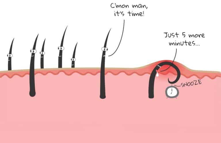 How To Get Rid Of Ingrown Facial Hair Causes Prevention And Removal