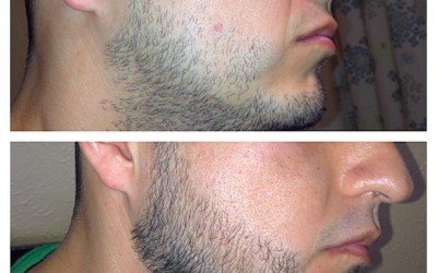 Minoxidil for Beard: Does It Really Boost New Growth