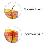 Ingrown Facial Hair: How to Prevent & Get Rid of It For Good