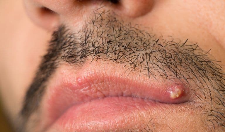 How To Get Rid Of Ingrown Facial Hair (Causes, Prevention ...