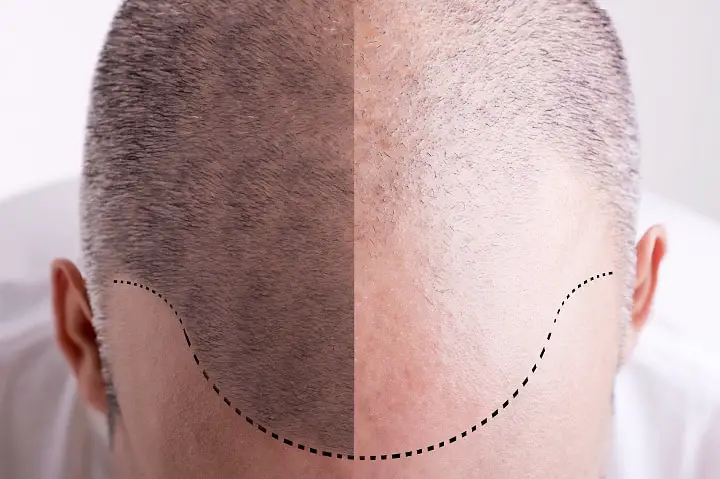 Things to Consider Before Going Bald - Shiny vs Natural