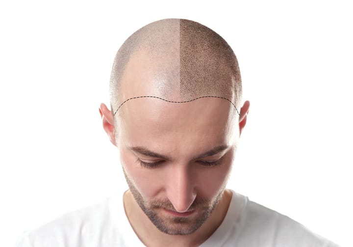 Techniques for Balding Men