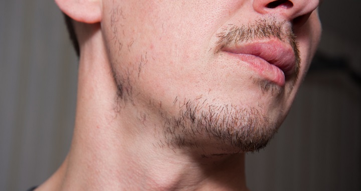 Patchy Beard Growth Pattern
