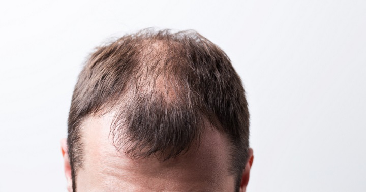 Men Are Hiding Baldness With Man Buns, But It's Riskier Than You Think |  Bored Panda