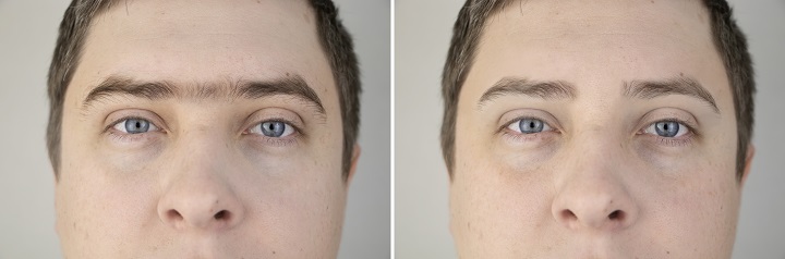 Men With and Without Unibrow