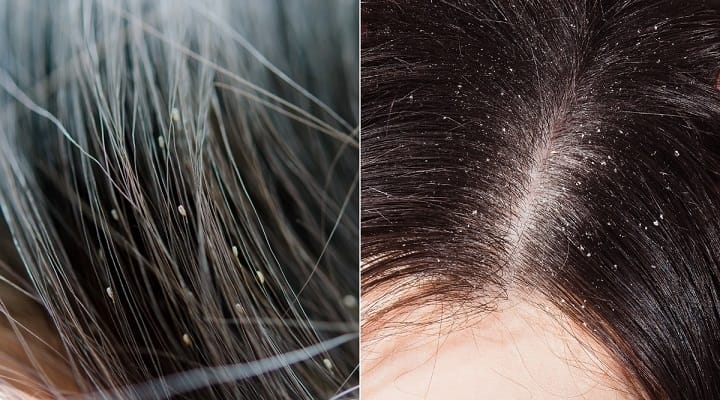 Head Lice in a Hair