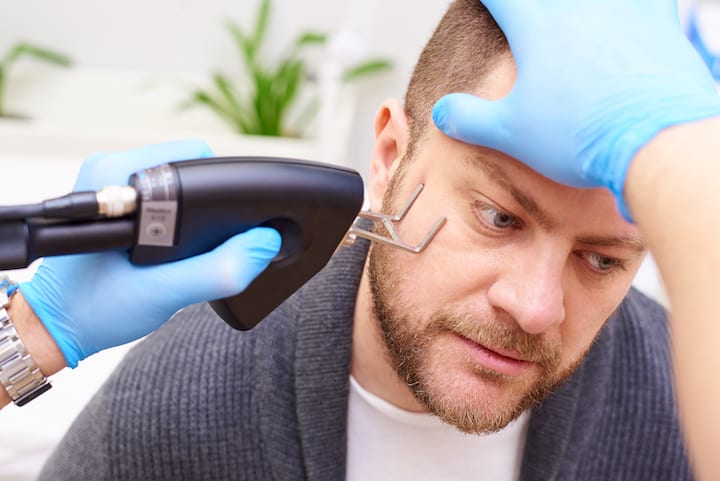 Laser Procedure for Beard Growth